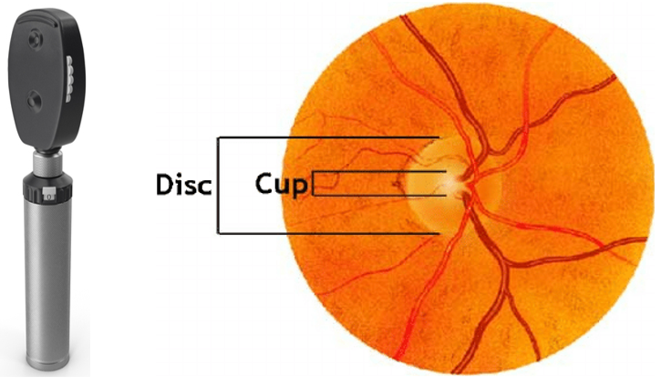 Cup-Disc Assessment with Ophthalmoscope