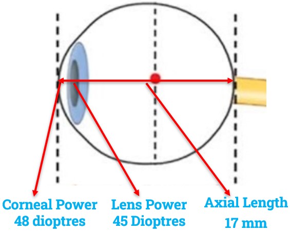 Eyeball at Birth with Corneal Power 48D, Lens power 45D & Axial length 17mm