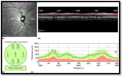 RNFL assessment in OCT for Glaucoma Diagnosis