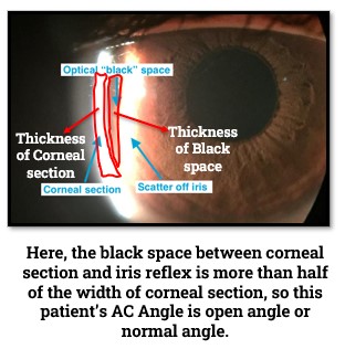 Van Herick technique for Glaucoma Diagnosis