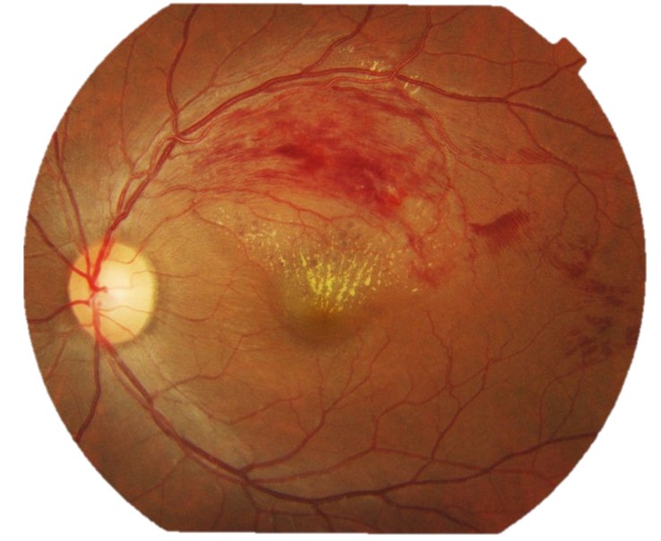 Branch Retinal Vein Occlusion (BRVO)