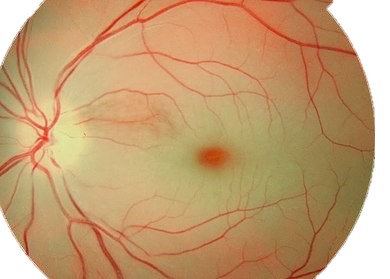 Central Retinal Artery Occlusion (CRAO)