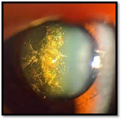 Christmas Tree Cataract