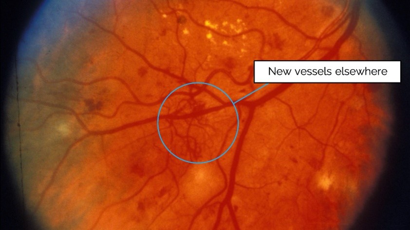 Proliferative Diabetic Retinopathy (PDR)