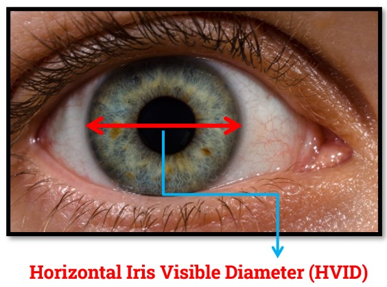 Horizontal Iris Visible Diameter (HVID)