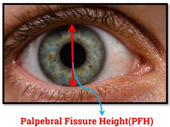 Palpebral Fissure Height (PFH)