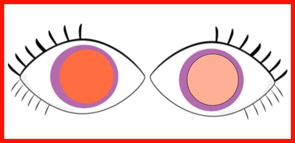 Anisometropia in Bruckner's Test