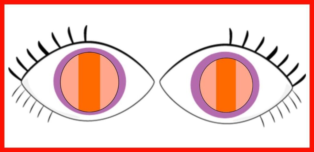 Astigmatism in Bruckner's Test