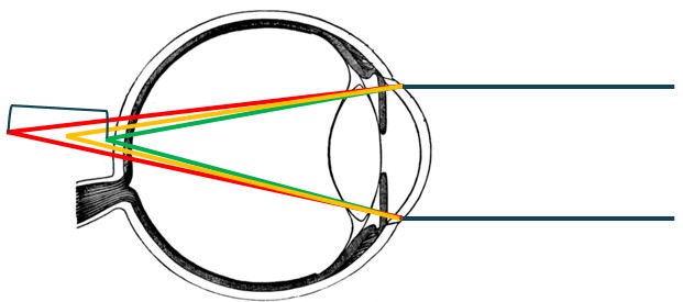 Chromatic Aberration in Hyperopia