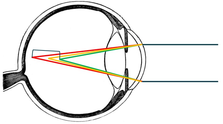 Chromatic Aberration in Myopia