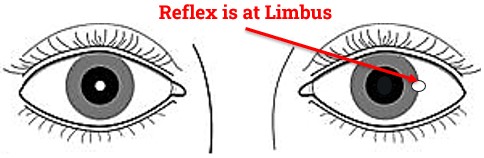 Corneal Reflex is at Limbus in Hirschberg test