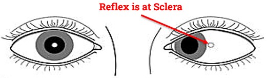 Corneal Reflex is at Sclera in Hirschberg test