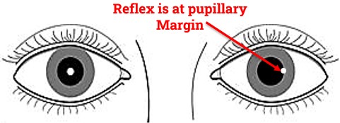 Corneal Reflex is at pupillary Margin in Hirschberg Test