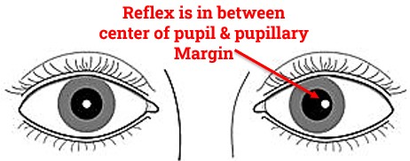 Corneal Reflex is in between center of pupil & pupillary Margin (Hirschberg Test)