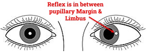 Corneal Reflex is in between pupillary Margin & Limbus in Hirschberg test