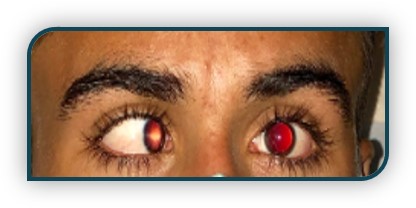 Esotropia in Bruckner Test