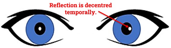 Esotropia in Hirschberg Test