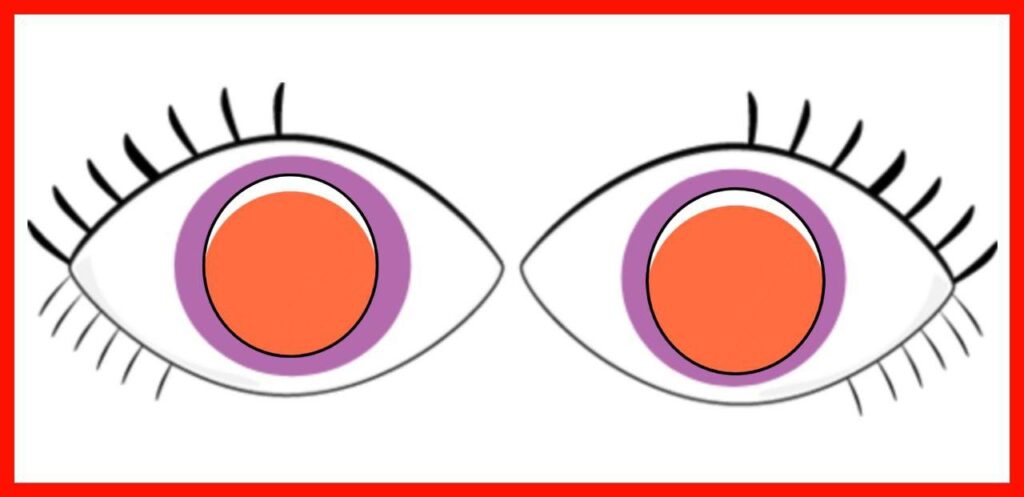 Hypermetropia in Bruckner's Test