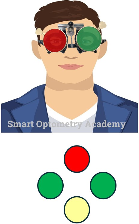 Binocular Single Vision in Worth 4 Dot Test