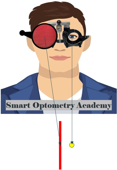 LE Esotropia in Maddox Rod Test