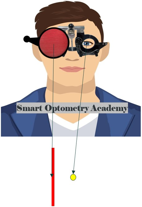 Esotropia or Uncrossed Diplopia in Maddox Rod Test