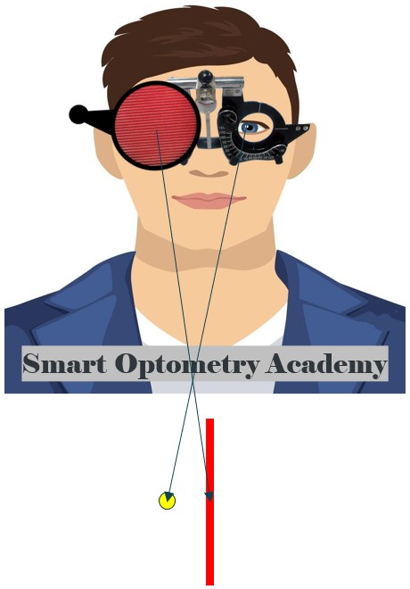 LE Exotropia or Crossed Diplopia in Maddox Rod Test