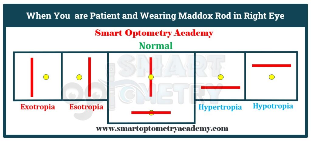 Interpretation Table of Maddox Rod Test