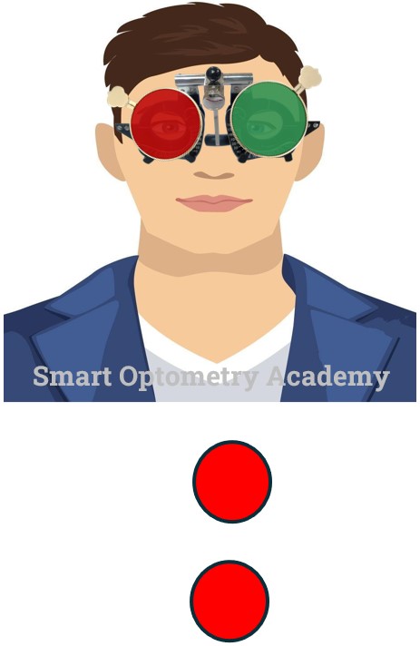 Left Eye Suppression in Worth 4 Dot Test