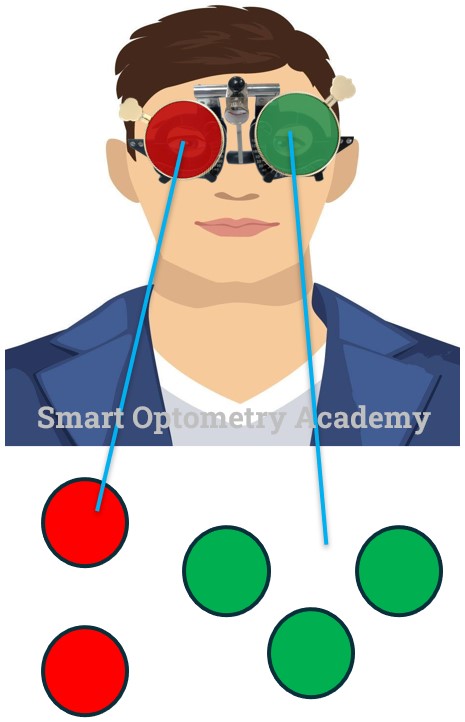 Uncrossed Diplopia or Esotropia in Worth 4 Dot Test