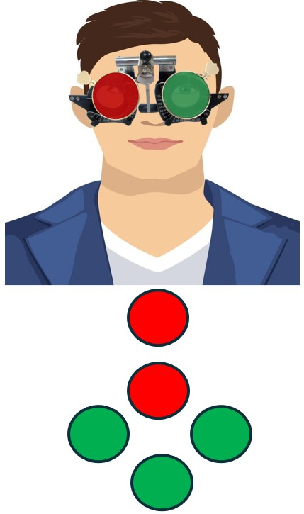 Vertical Diplopia or Right Eye Hypotropia or Left eye Hypertropia in Worth 4 Dot Test