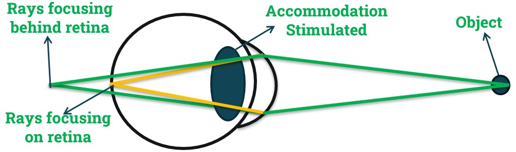 Accommodation stimulation in Hyperopia