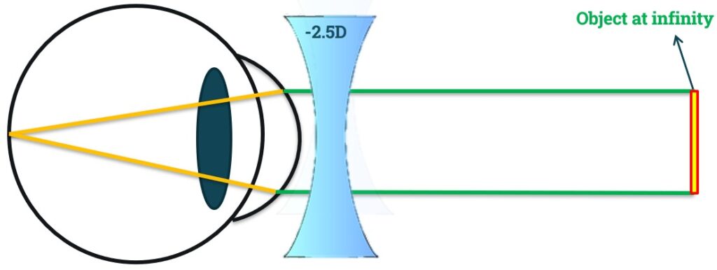 Mechanism of accepting over correction in myopia