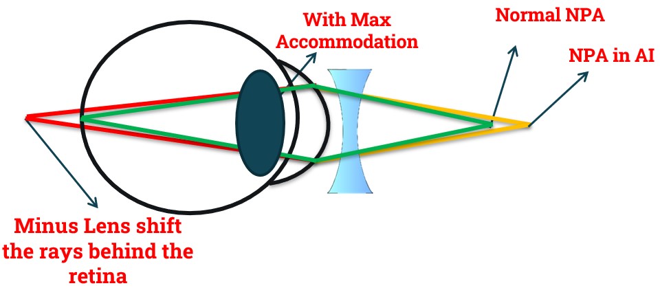 Why Minus Lens Difficulty in Accommodation Insufficiency