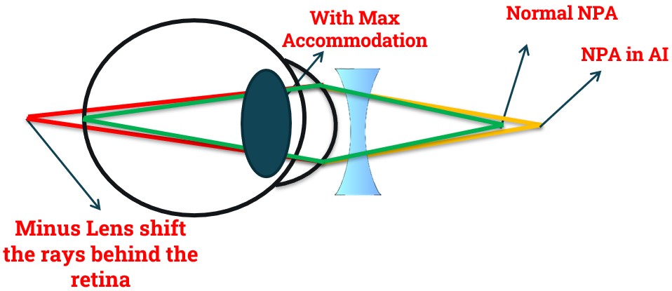 Why Plus lens Difficulty in Accommodation Excess