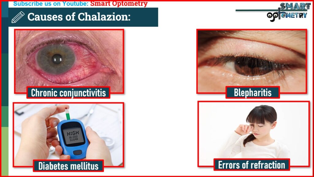 Causes of Chalazion