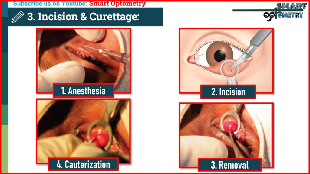 Incision & Curettage procedure in Chalazion