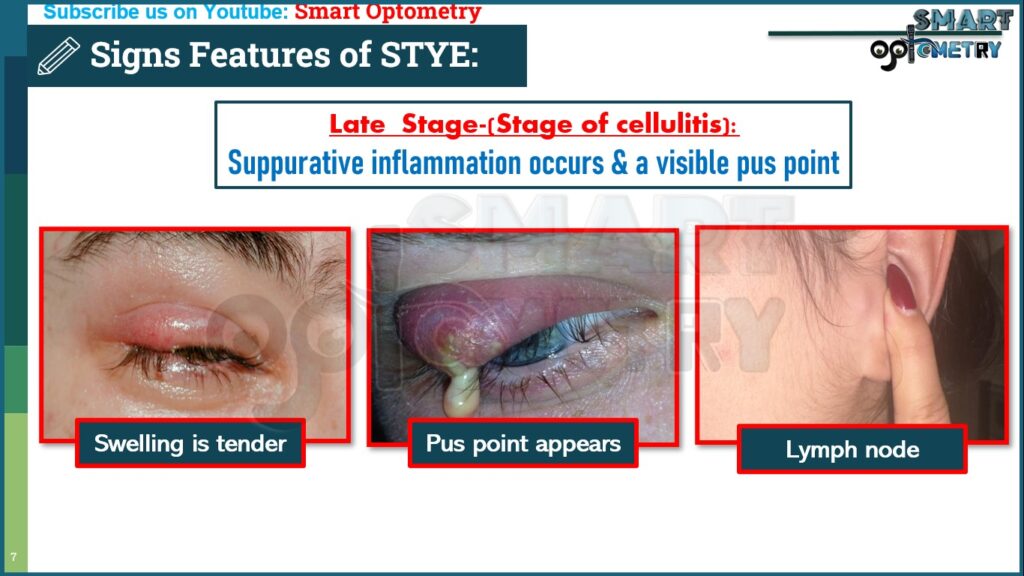 Signs of Late stage of Stye or External Hordeolum