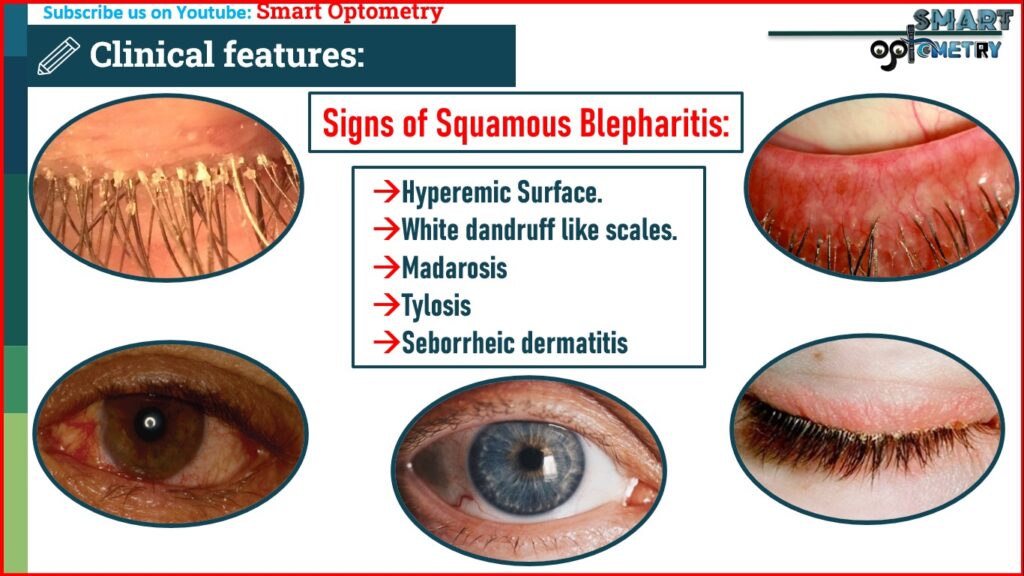 Signs of Squamous Blepharitis