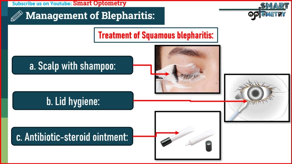 Treatment of Squamous Blepharitis