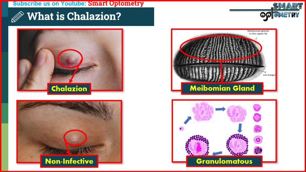 What is Chalazion