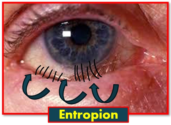 What is Entropion?