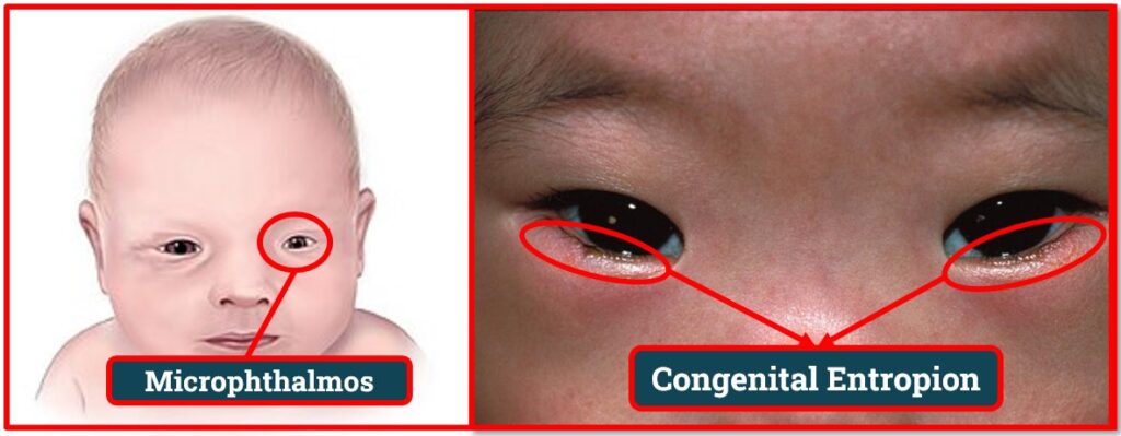 Congenital Entropion