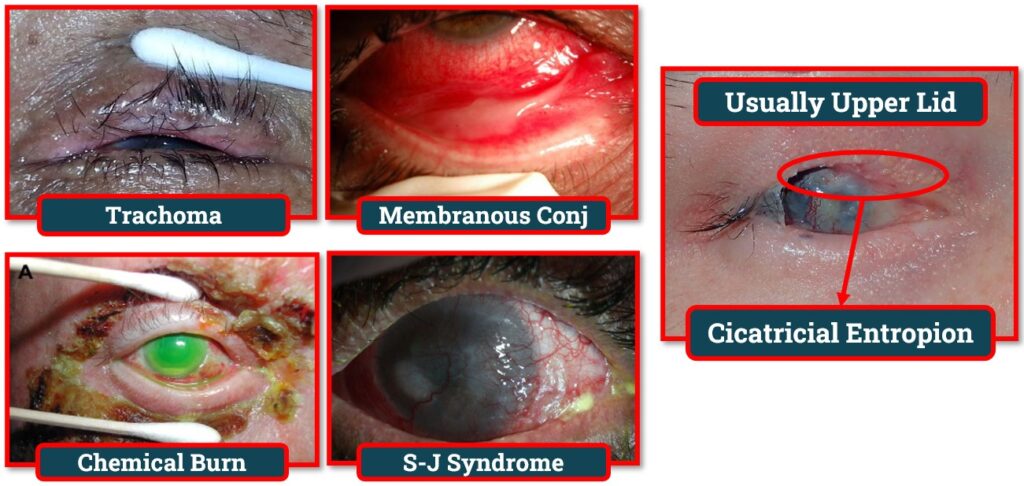 Cicatricial Entropion