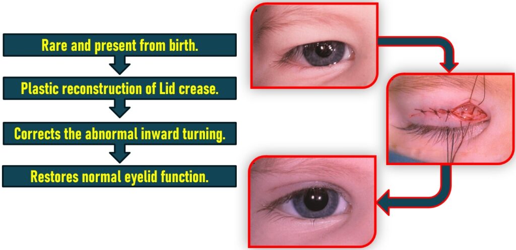 Treatment of Congenital Entropion