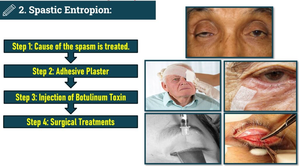 Treatment of Spastic Entropion