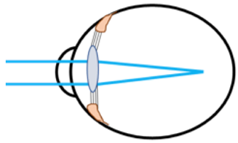 Myopia- Everything you need to know. - Smart Optometry