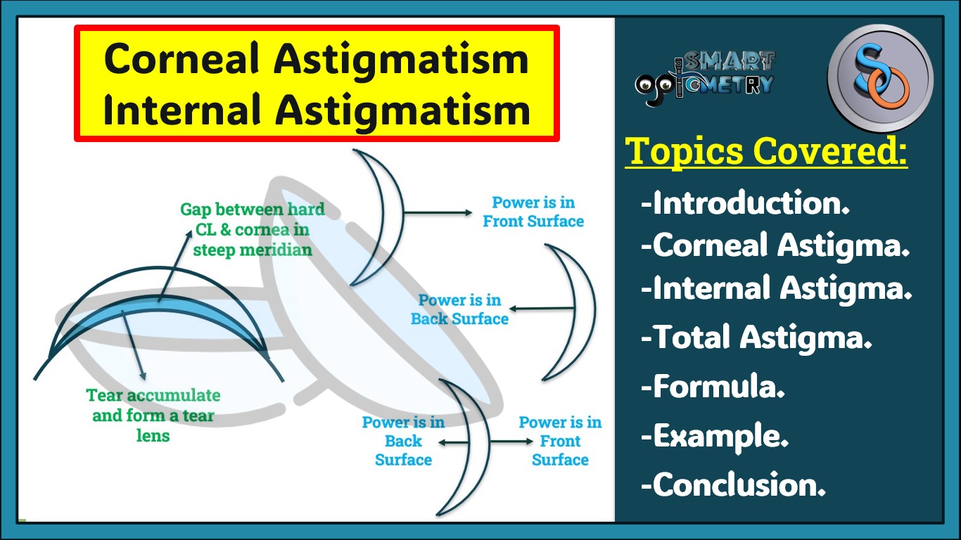 Blog- Corneal Astigmatism & Internal Astigmatism