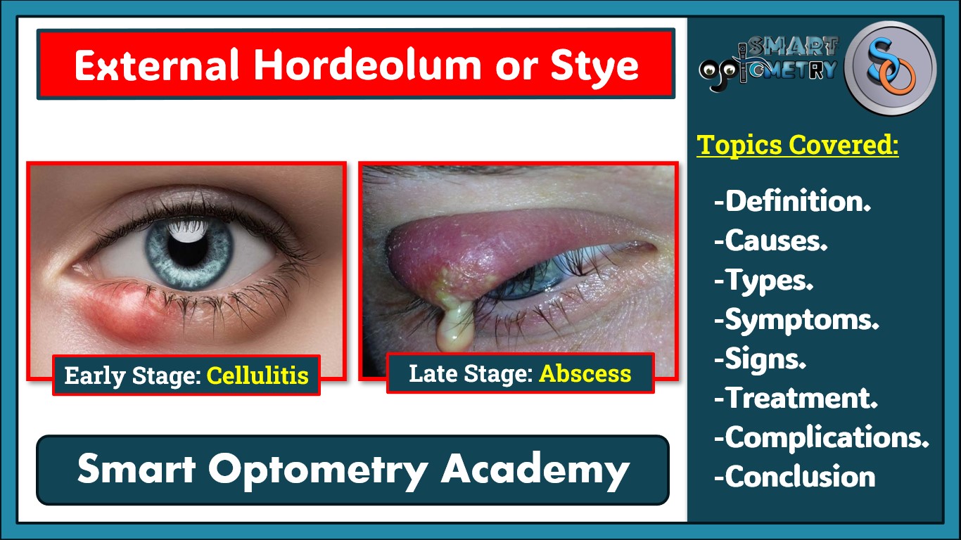 Blog- External Hordeolum or Stye