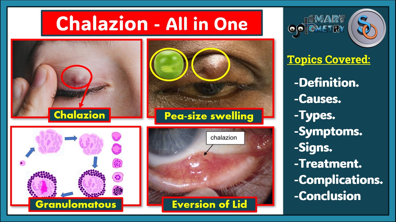 Chalazion All You Need to Know