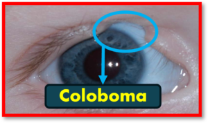 6 Congenital Anomalies of Eyelid- Every Optometrists Should Know ...
